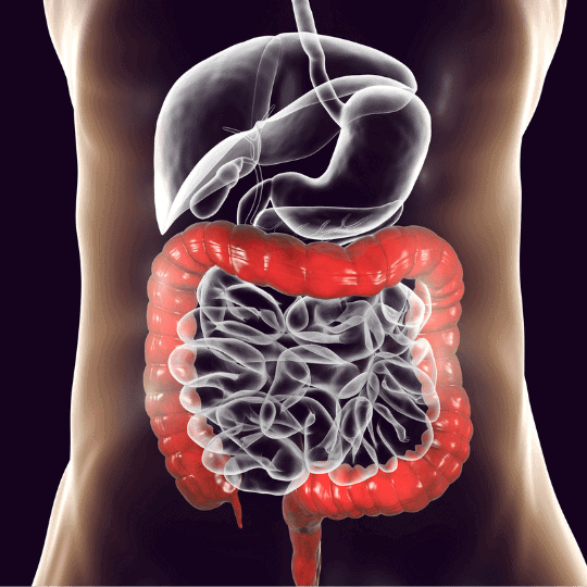 Morbus Crohn