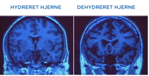 Når hjernen mangler væske ældes den hurtigere